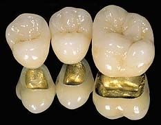 金属烤瓷牙种类多 适宜自己最重要