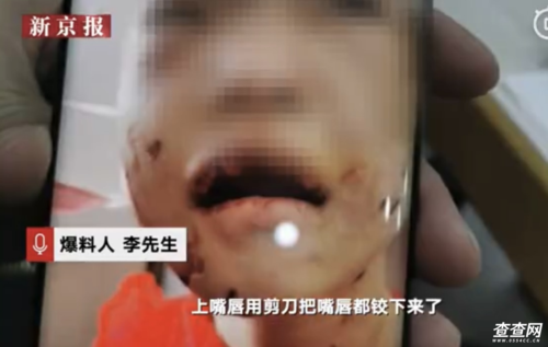 4岁女童遭继母殴打进icu:嘴唇被剪烂,浑身都是伤,仍处于昏迷状态!
