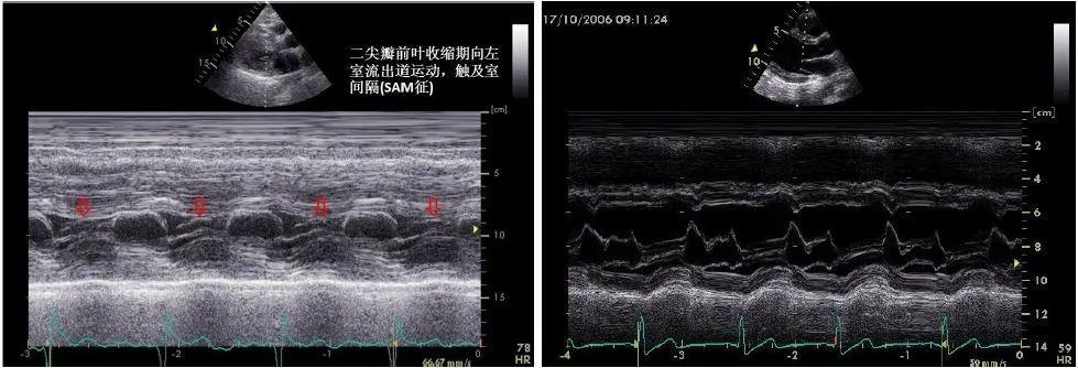 二尖瓣可见偏心性返流,提示该患者存在sam征