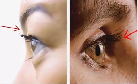什么是眼窝凹陷