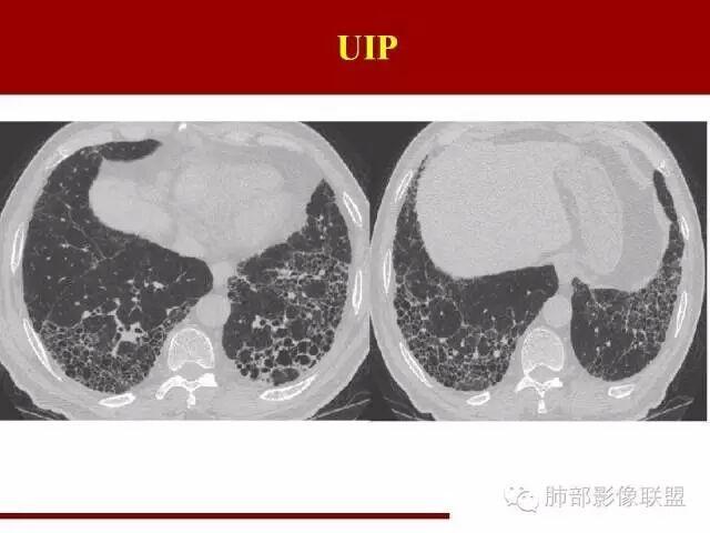 其它 间质性肺炎的分类及简单介绍 写美篇 影像上下结论的时候建议用