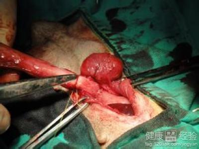 子宫脱垂有什么影响