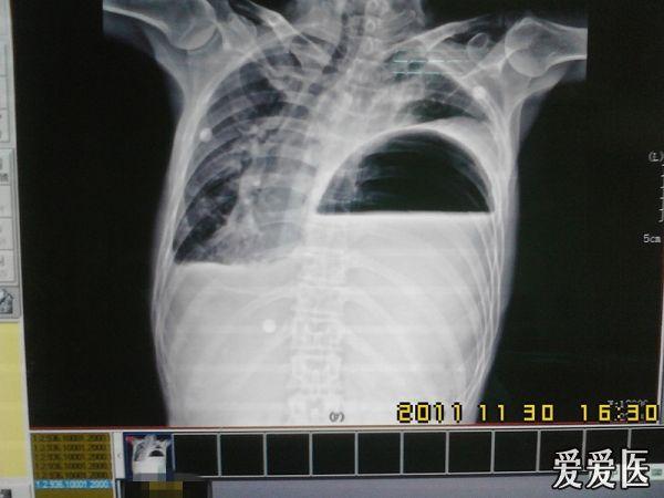 看到这张片子你会想到左侧膈疝