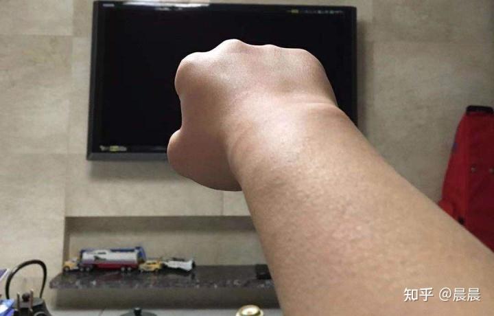 钢琴手的复健:手腕三角软骨损伤