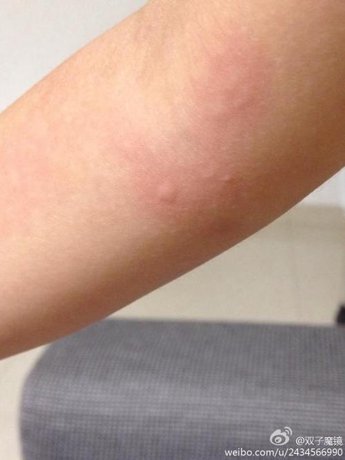 过敏的症状一般是红色的小点,没这么大.