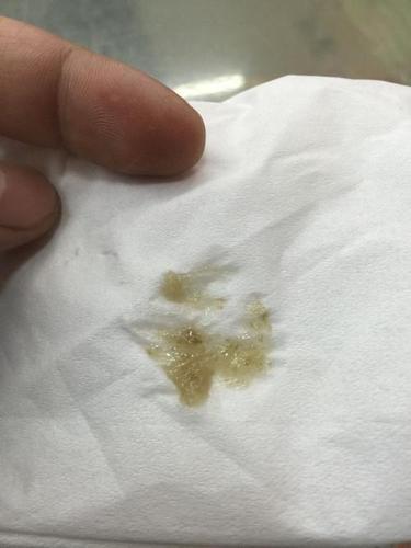 ⑦黄绿色或翠绿色痰,提示铜绿假单胞菌感染; ⑧痰白黏稠且牵拉成丝