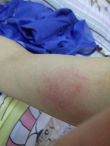 评论|  3 分钟前 |来自|一级 可能是过敏了,擦点红霉素软膏!