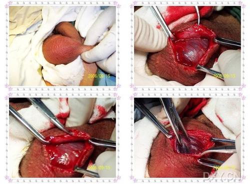 【讨论】睾丸扭转2例(多图),警钟应长鸣 [精华] [病例帖]