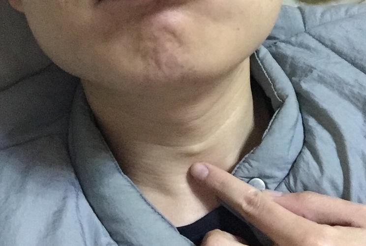 问:喉结底下长了一个绿豆大小的硬块 做了超帮忙看看要不要去手术