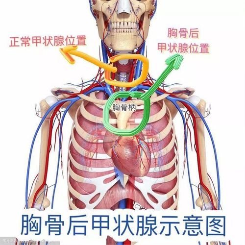 "淘气"的甲状腺结节"跑"到了胸骨后 怎么办?
