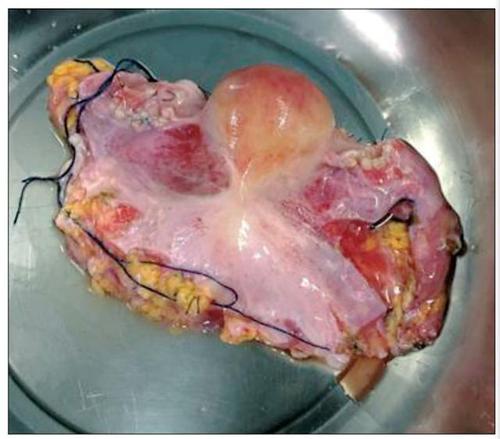 柳叶刀:人类首次!已故捐献者的子宫移植后成功分娩!