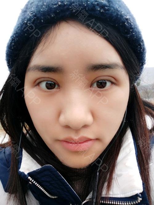 全切加开眼角一个月了左右两边恢复情况不一样还是有点不对称有几天