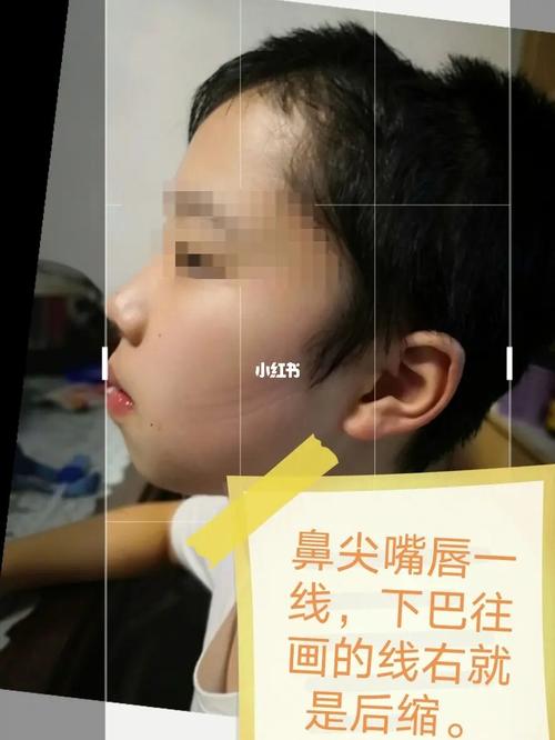 腺样体面容 基本辨认法