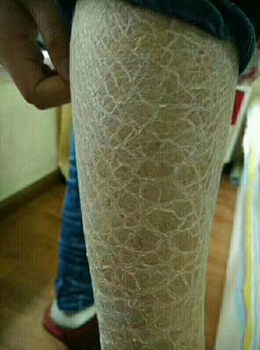 13岁女孩鱼鳞皮肤病