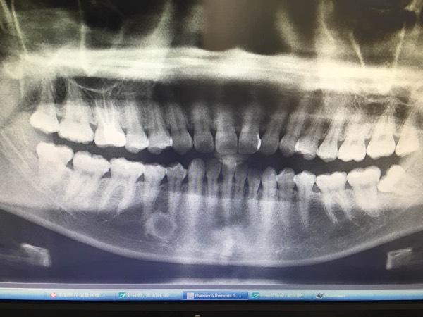 这是牙齿的x光片,那个牙齿根部的圆形是什么东西,要不要紧
