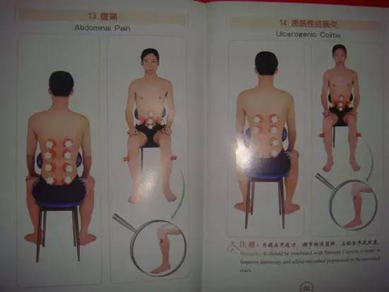 最全拔罐穴位疗法图解:拔上一罐,病去一半!