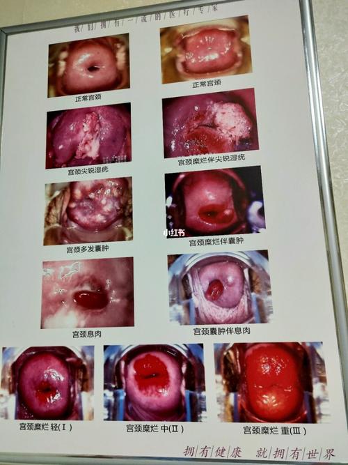 宫颈糜烂一般为慢性宫颈炎的一种临床表现,根据糜烂的面积一般分为
