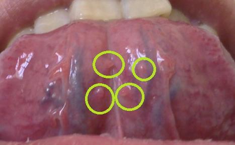 女性尖锐湿疣晚症状有哪些呢
