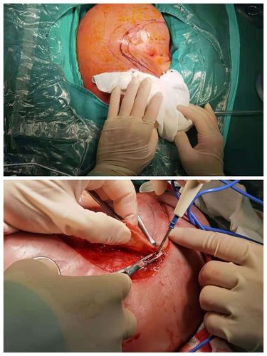 骶尾部巨大畸胎瘤手术成功切除,32周早产儿重获新生.