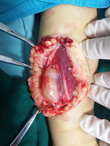 前臂神经纤维瘤