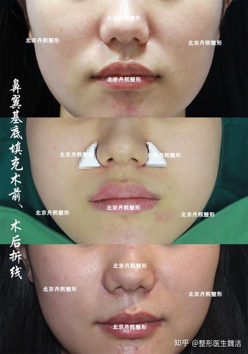鼻基底凹陷填充对比照片加强型膨体垫鼻翼基底