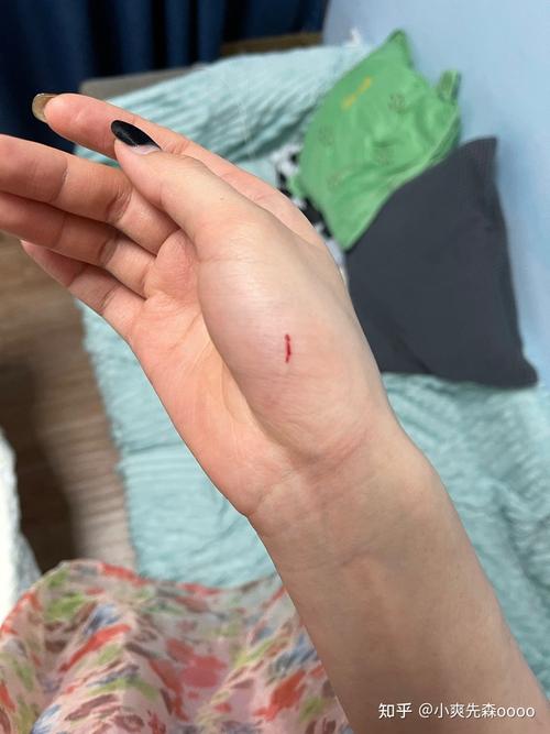 被兔子抓出血要打疫苗吗?