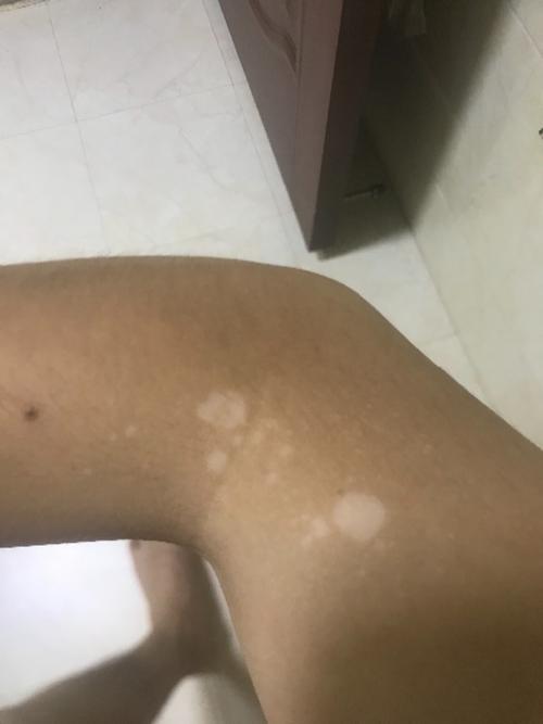 到底汗斑 还是白癜风 医生说是汗斑 这么又治不好