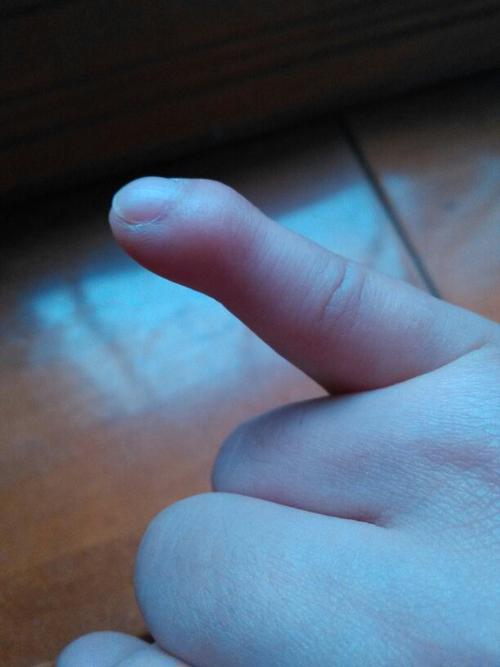 我今年25女,小拇指从小就短并且弯曲,指甲盖也是,请问这是什么病?