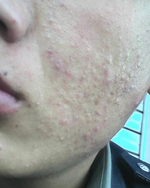 从十五岁开始的,起粉刺,黑头,皮肤还经常 我 暗红色!