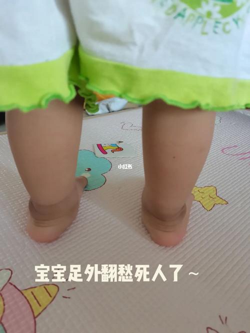 足外翻的小脚丫_足外翻_宝宝日常_萌娃_宝宝日常