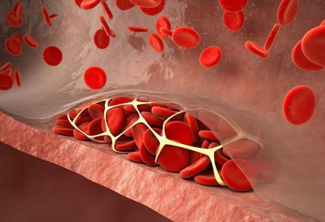 血栓来临时,身体会有4个表现,若你有,需提高警惕