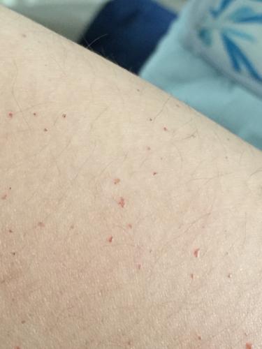 会不会是白血病的前兆