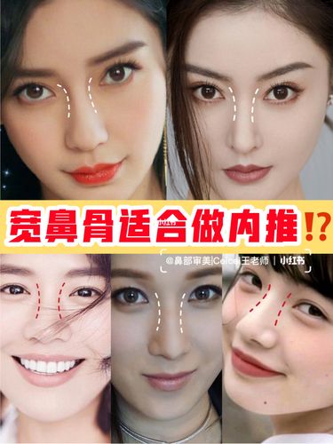 鼻部审美宽鼻骨真的适合做鼻骨内推吗