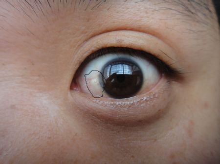 红红的有血丝,有时间会感觉有异物在眼里,还有这种透明突出点和黄斑