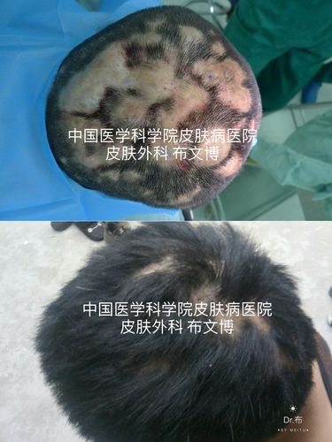 化脓性汗腺炎可以治疗,可以治愈