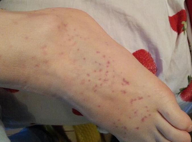 过敏性紫癜会遗传吗