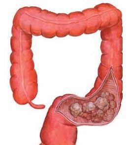结肠癌的高发人群,身体出现这几个信号需要注意了!