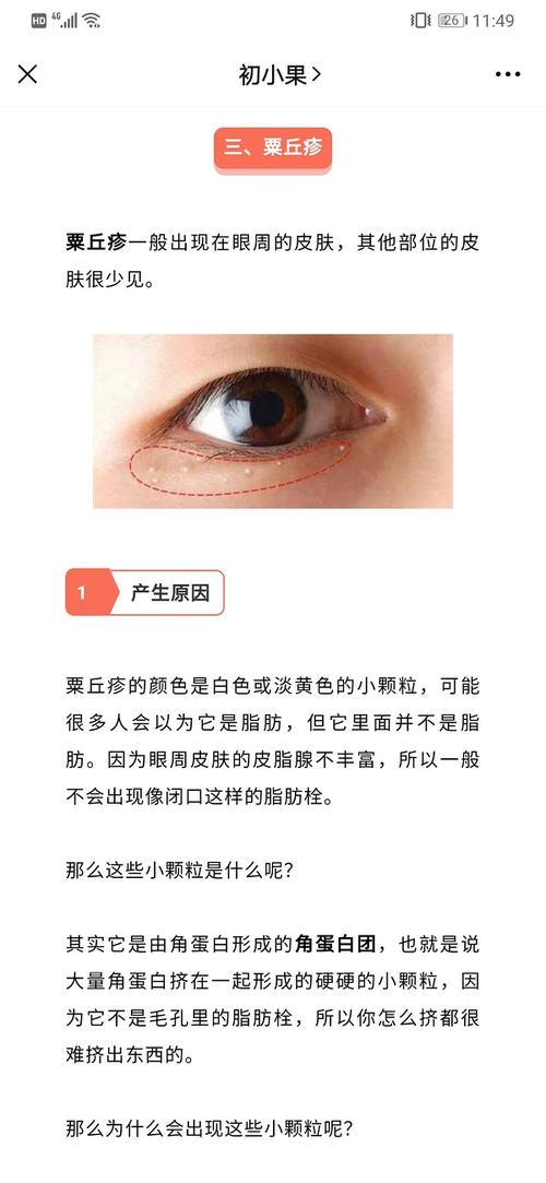 眼下这些小颗粒是什么呀怎么祛除(慎入 有点可怕