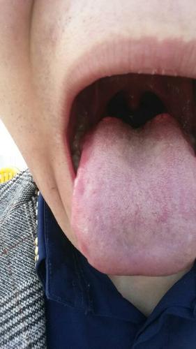 舌根里面几个泡泡是什么? 急～ 在线等