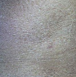 皮肤科 鱼鳞病 症状