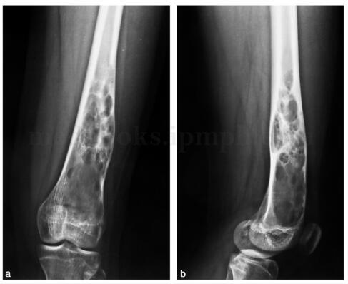 如何区分单纯性骨囊肿和动脉瘤样骨囊肿?