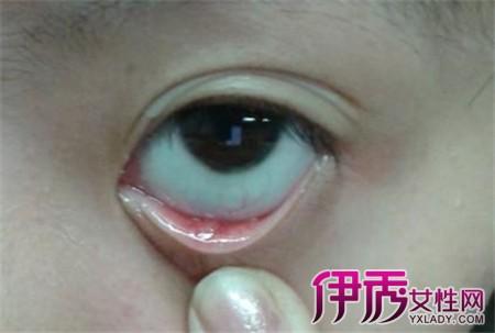 眼睑炎的临床症状