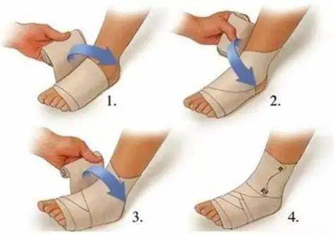 c-compression 加压 可以使用弹性绷带加压包扎,来缓解关节的炎症