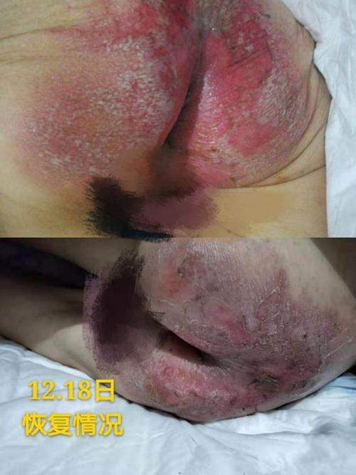 失禁性皮炎治疗