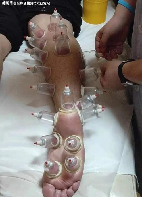 没走几步路就小腿酸,胀,这是湿寒沉积,可以靠拔罐调理