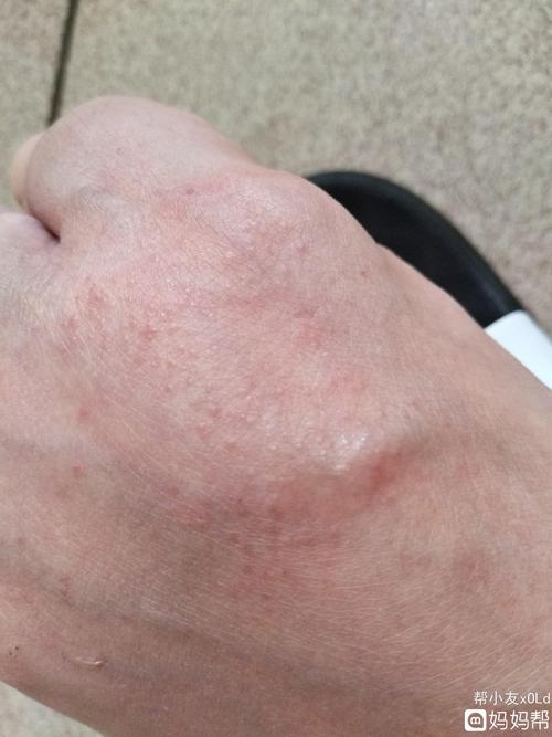 37 6周,脚背上长这个小水泡样的,是不是湿疹