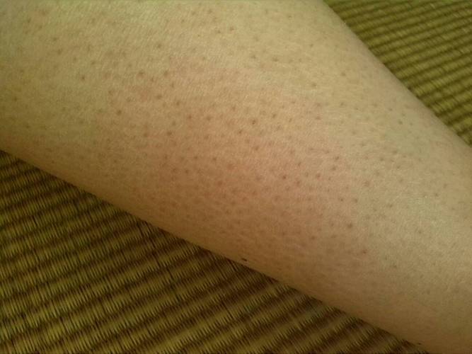 问:腿上都是这样的疙瘩,应该是鸡皮肤,摸起来很粗糙,毛孔里还有曲着的