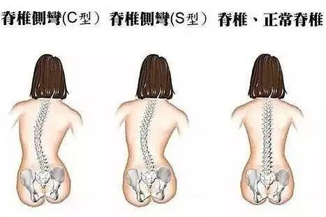 科普:脊柱侧弯加重,可能是遗传基因在"作祟"