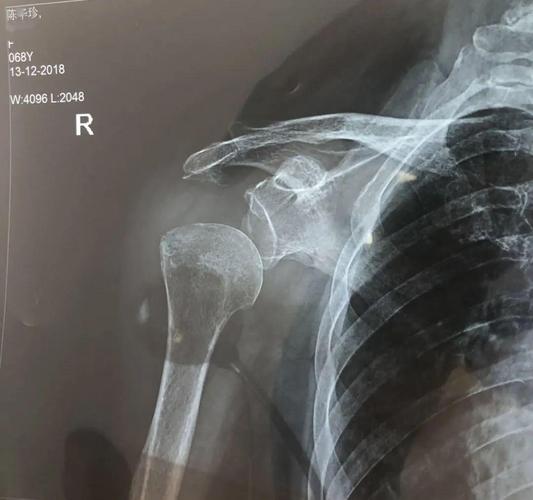 疑难杂症肩关节半脱位浮针也能治