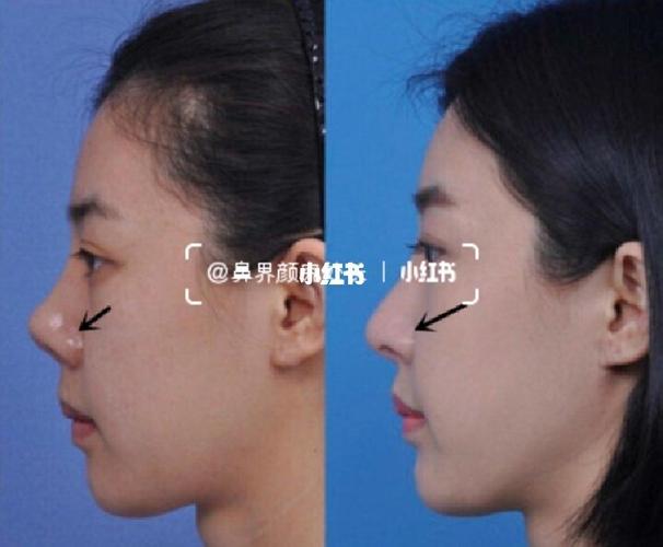 垫鼻基底后鼻孔朝天,是哪里出了问题?_鼻子_法令纹_凸